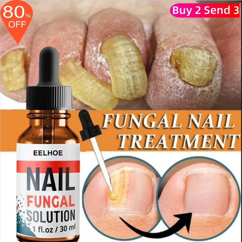 Foot Finger Liquid Anti Fungal Repair Serum Nail Removal Gel
