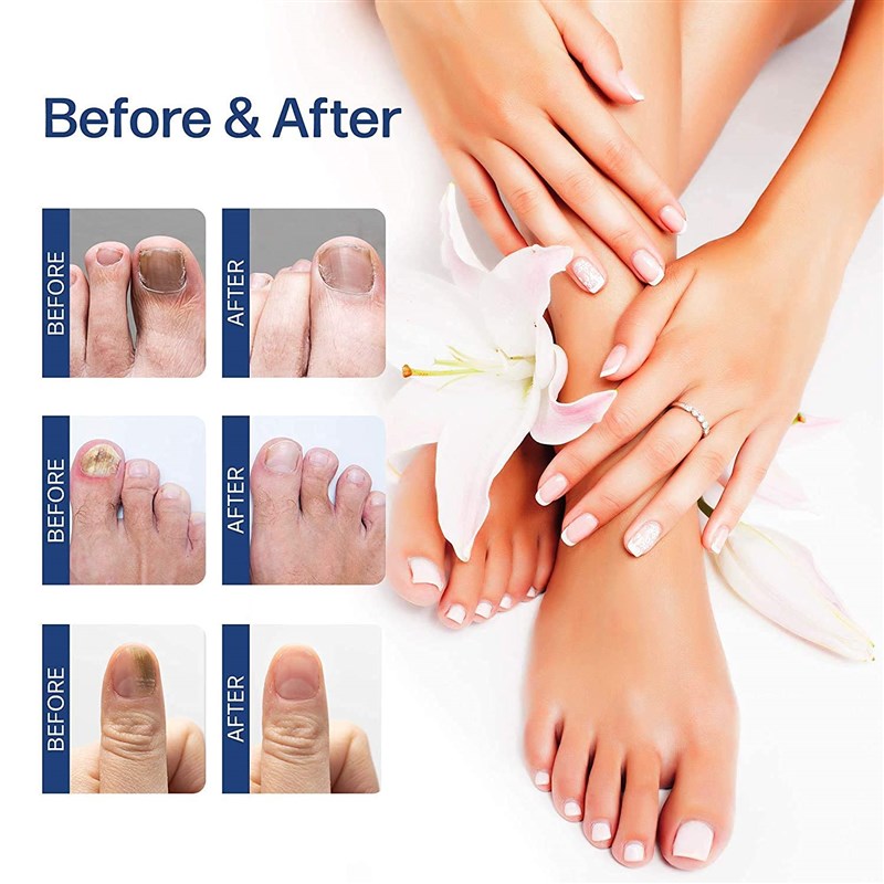 推荐SUAI Nail Fungal atment Feet Care Essence Foot Repair Na