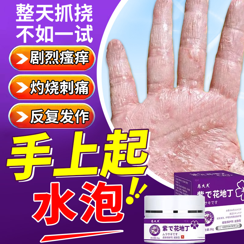 手上起小水泡汗状疱疹止痒干裂脱皮专用真菌感染手指瘙痒起皮膏YA