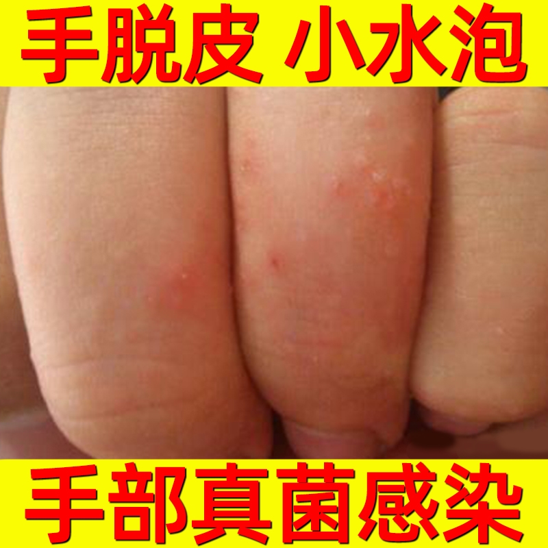 手指疱疹