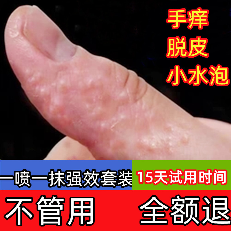 鹅掌风特效药手蜕皮手指脱皮药膏汗状疱疹专用软膏手气膏真菌感染