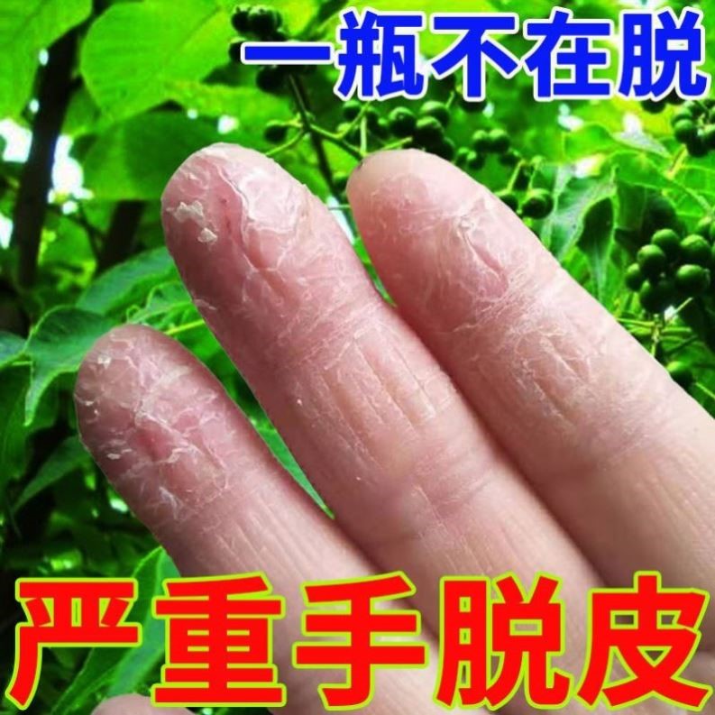 治疗手脱皮的药膏真菌感染手指头手部鹅掌风干裂手癣修复汗疱疹膏
