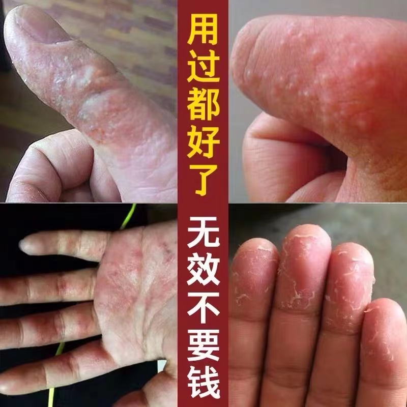 鹅掌风真菌感染手癣膏脱皮干裂抑菌汗疱疹手部脚癣手足藓专用药膏