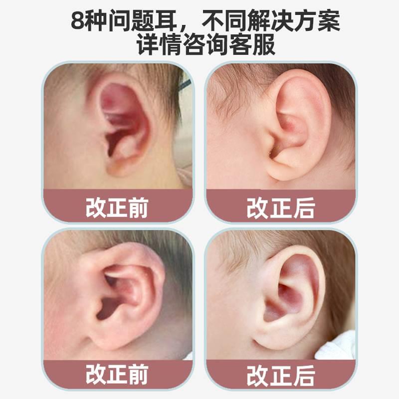 耳朵矫正器婴儿招风耳贴面耳硅胶无创幼儿纠正耳廊矫形器耳垂弯曲
