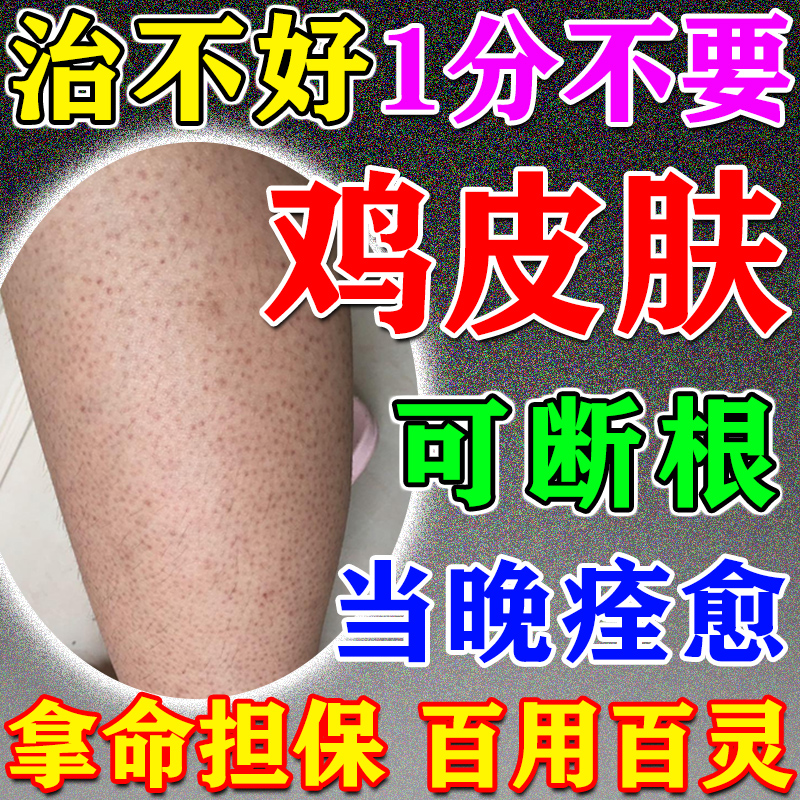 鸡皮肤疙瘩毛囊角化药膏改善脸上手臂腿去除毛周角化症儿童身体乳