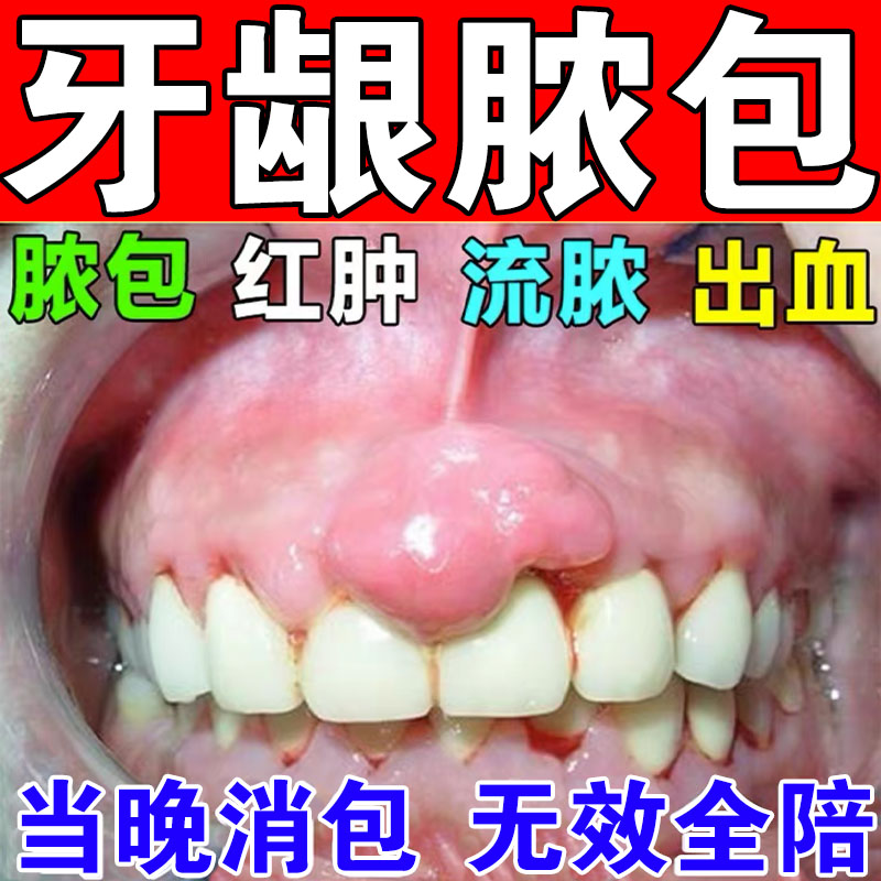牙龈脓包牙根发炎治肿包痛消炎上火肿包肿痛牙周炎儿童专用药喷剂