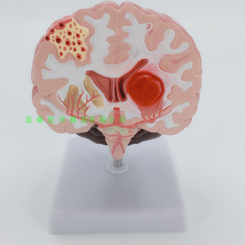 大脑的皮质 灰质 脑干 脑病变 大脑动静脉畸形 脑病理 结构模型