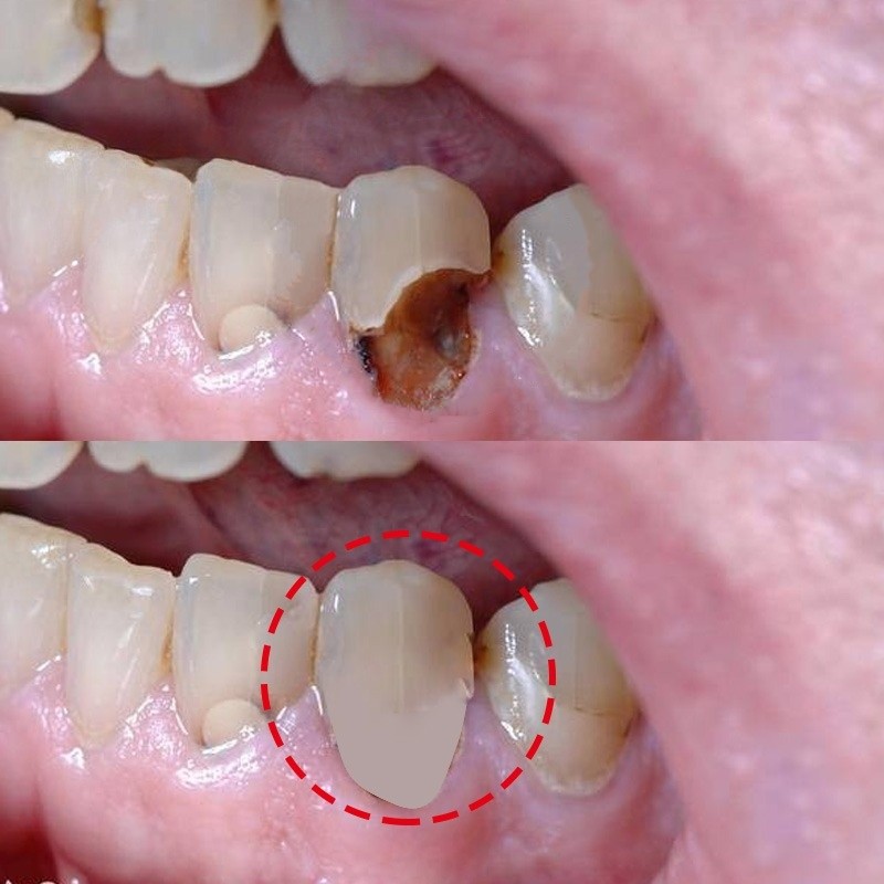 不净包退-蛀牙神器 防蛀牙齿洞牙裂牙缝坏牙牙虫牙蠕 清新口气