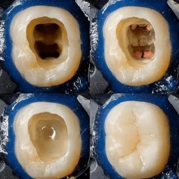 不净包退-蛀牙神器 防蛀牙齿洞牙裂牙缝坏牙牙虫牙蠕 清新口气