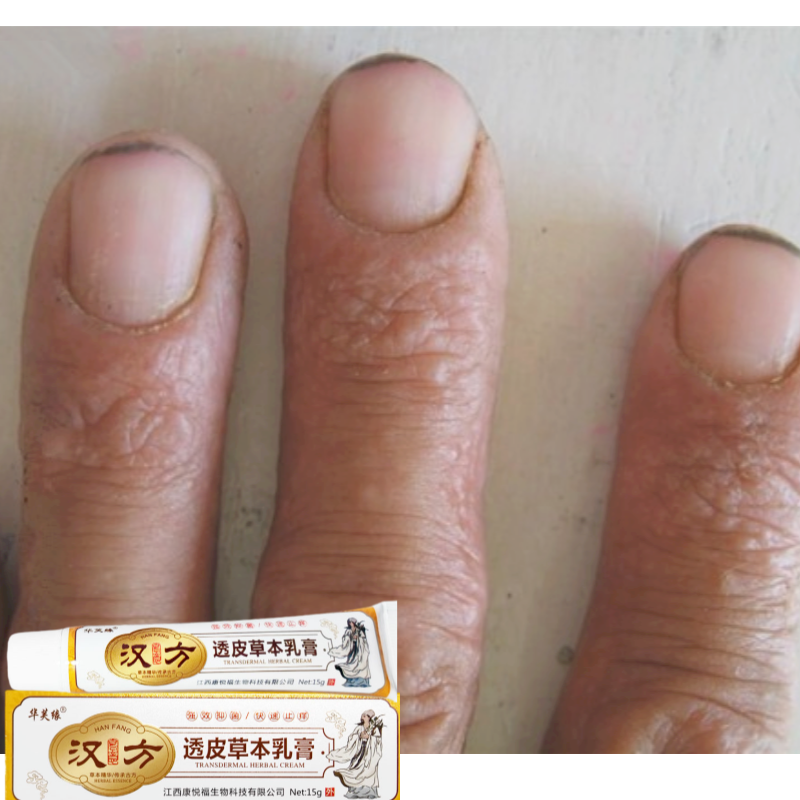 手指关节长硬疙瘩真菌感染小痘痘汗疱疹水泡痒身上痒痤疮手指疙瘩