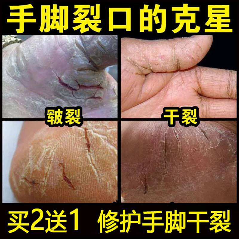 皲裂膏手指皮肤开裂龟裂药膏防干裂的脚后跟脚底防烈军裂膏修复。
