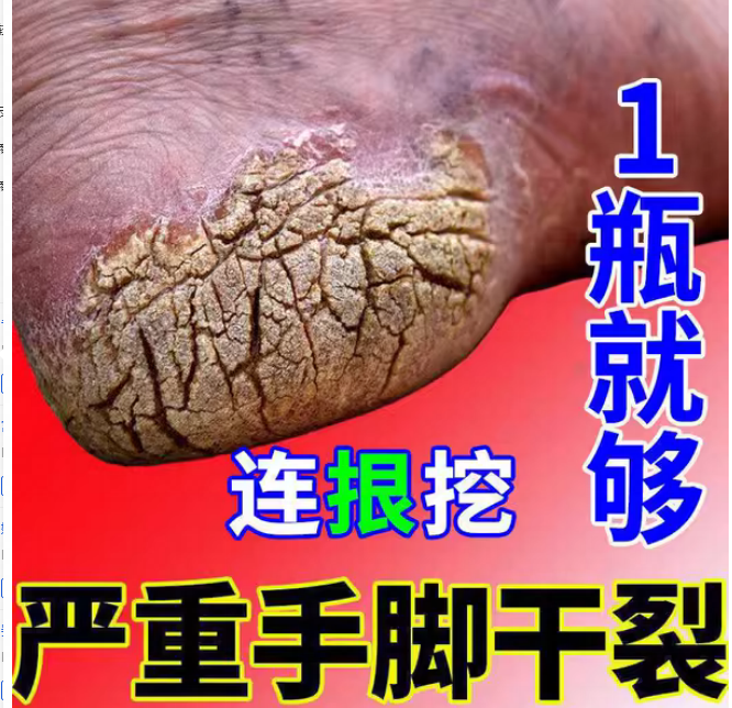 专治手裂的药膏防干裂手脚上开裂脚后跟真菌感染干燥皲裂修复霜