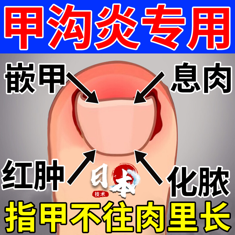 日本甲沟炎专用息肉去除消肿脚趾指甲往肉里长化脓嵌甲矫正液OL