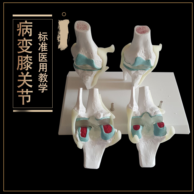 病变膝关节模型病态膝关节模型 变态四阶段 骨骼模型关节教学模型