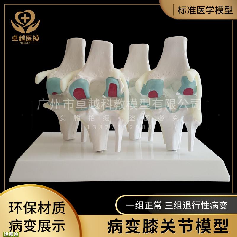 病变膝关节模型病态膝关节模型变态四阶段骨骼模型关节教学模具