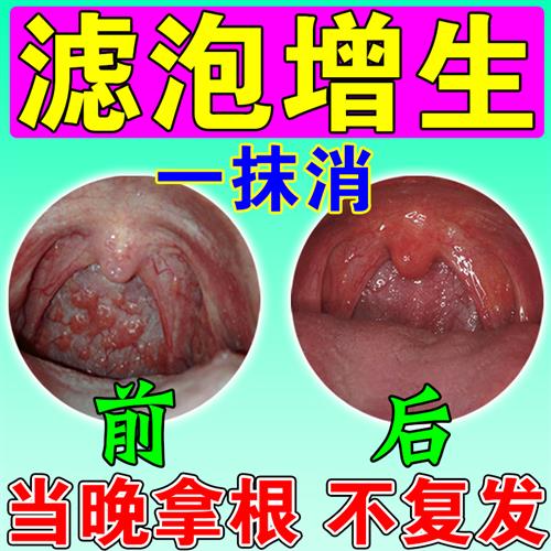 舌根淋巴滤泡增生咽後壁喉咙异物感有痰扁桃体发炎咽喉肿痛痒喷剂