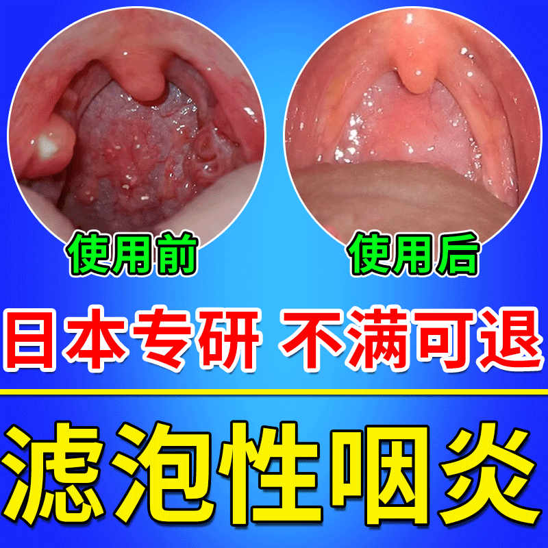 滤泡增生咽炎神器舌根淋巴咽后壁咽喉炎慢性咽炎治疗药HB