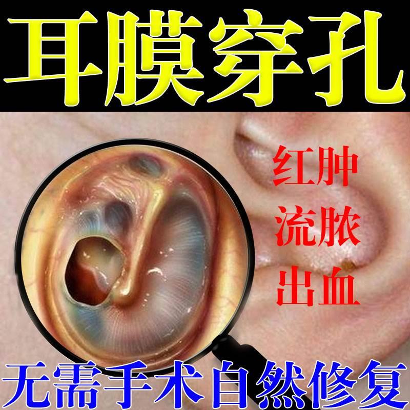 耳膜穿孔修复中耳炎耳鸣耳朵流脓发痒疼痛红肿听不清耳闷耳道湿疹
