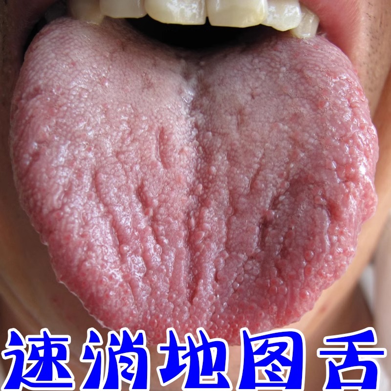 舌头裂纹有齿痕舌苔白厚舌下缐囊肿齿痕舌长跑口腔生疮疼痛抑菌剂