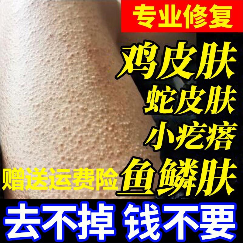 毛周角化症鸡皮肤疙瘩毛囊角化药膏手臂脸部腿上起皮角质去除神器