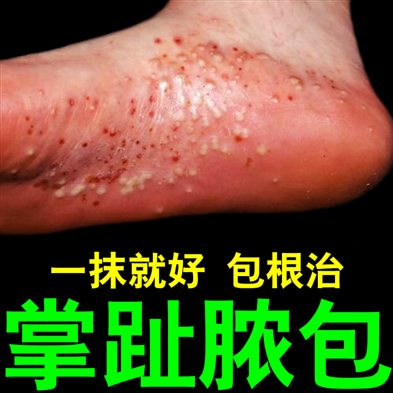 掌趾脓疱病治疗手脚脓包掌跖脓包角化病干裂蜕皮水泡专用药膏s