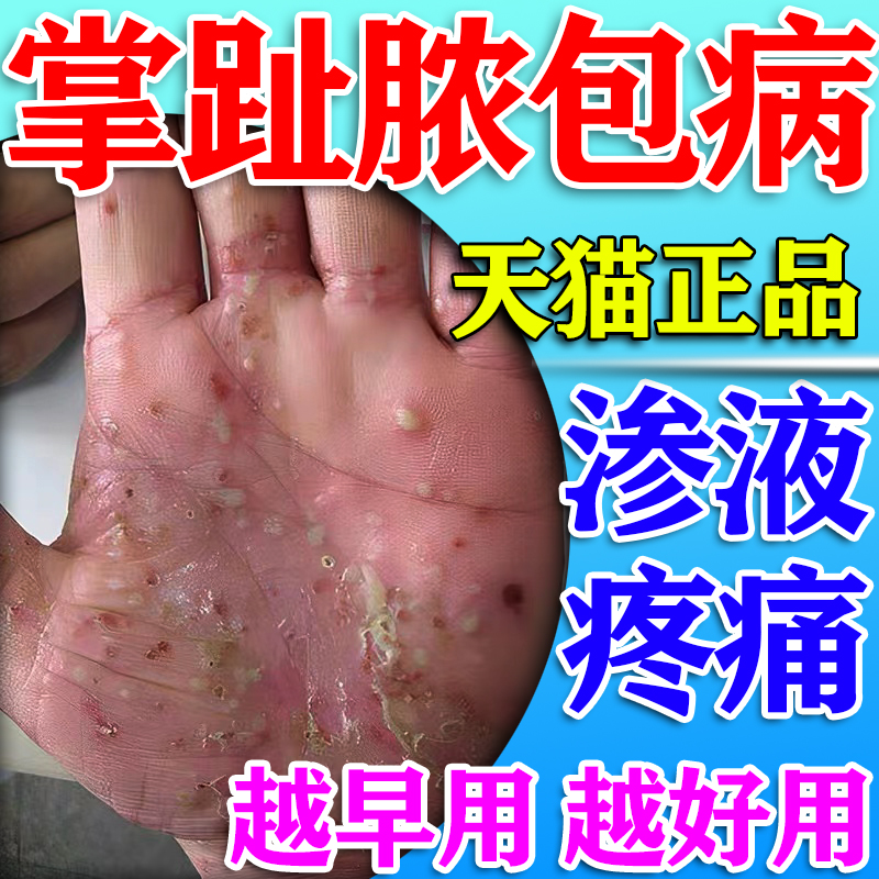 掌趾脓疱病剥脱性角质松懈症治疗手脚红斑脱皮干裂角皮症用专药膏