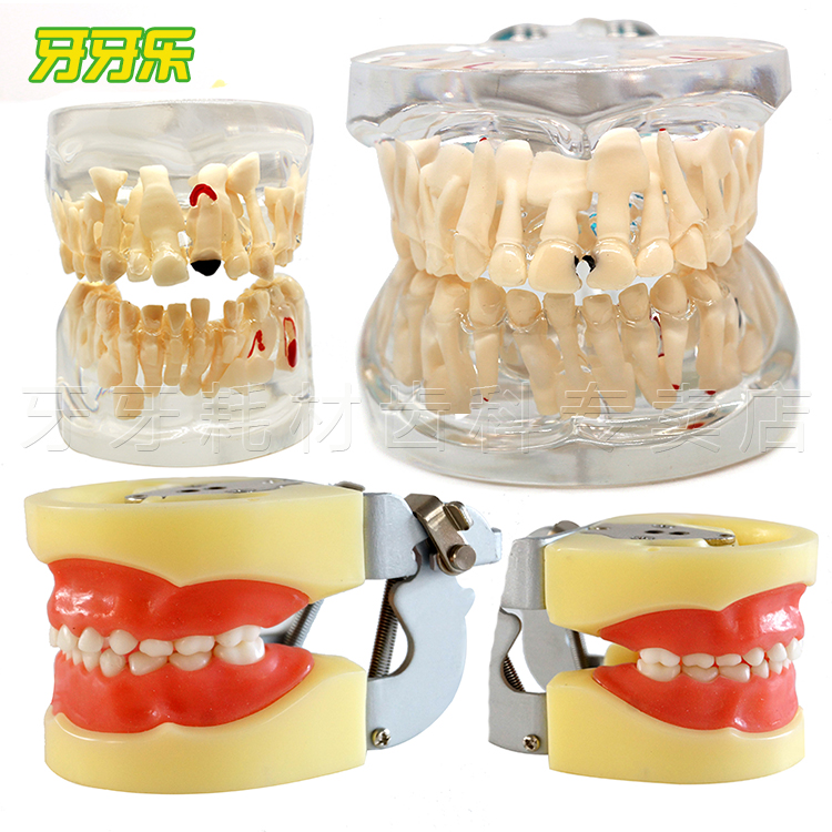 乳牙模型 恒牙模型 乳牙替换 病理 牙模型教学模型 窝沟封闭模型