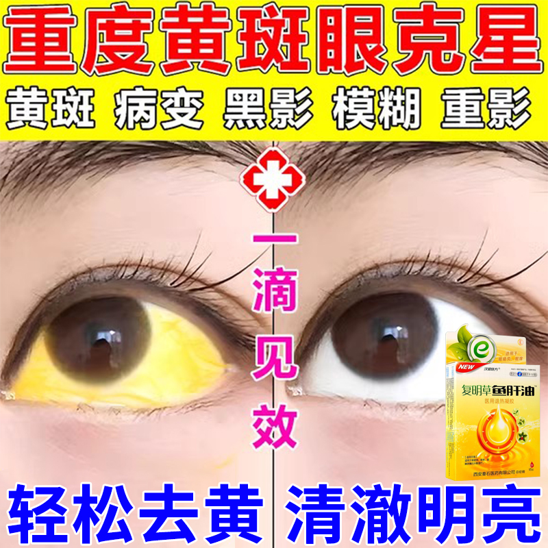 眼白清澈去黄神器眼睛红血丝去除眼睛黄斑裂孔有斑块异物感滴眼液