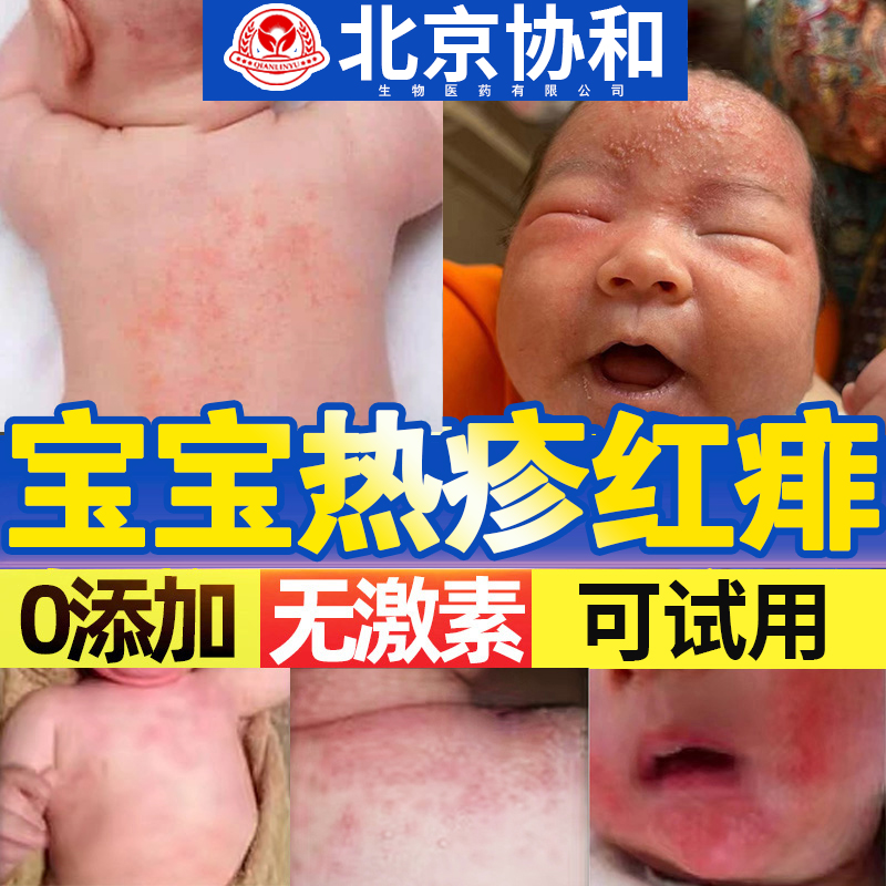 痱子粉湿疹儿童婴儿热痱子膏成人宝宝去痱子止痒热痱粉药房同售lx